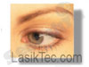 LASIK